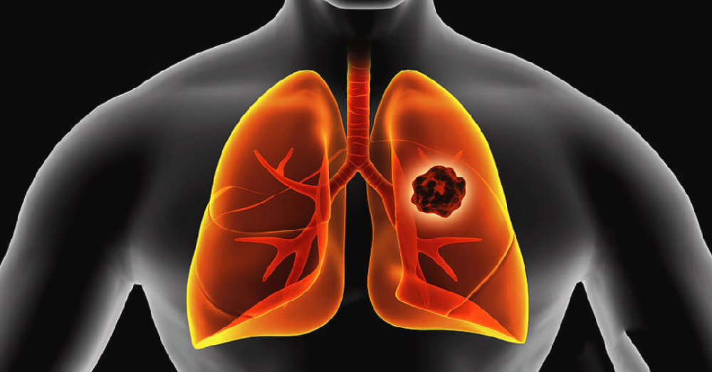 免疫细胞治疗可缩小或消除肺结节，控制癌变